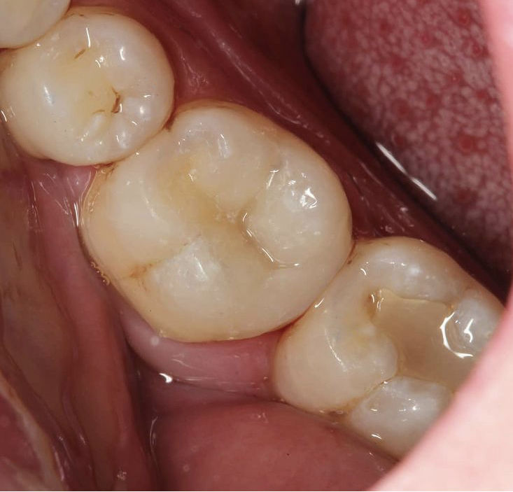 Kunststoff vs. Amalgam Füllung vorher und nachher